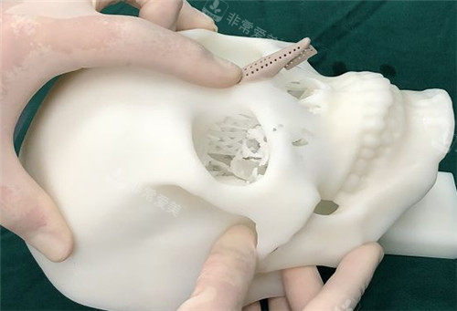 3d隆鼻手术设计图