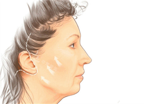 面部拉皮手术切口展示图