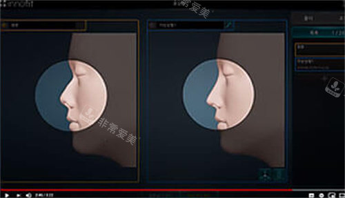 innofit 3D打印隆鼻成像模拟图