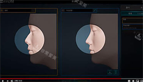 innofit 3D打印隆鼻成像模擬圖