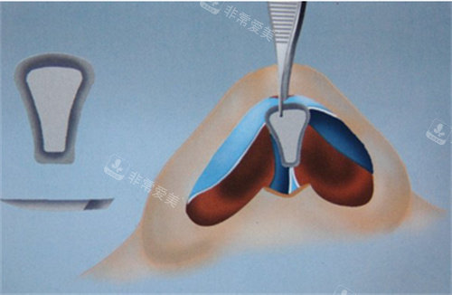 鼻子手术图