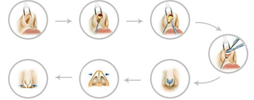 鼻子手术过程综合图
