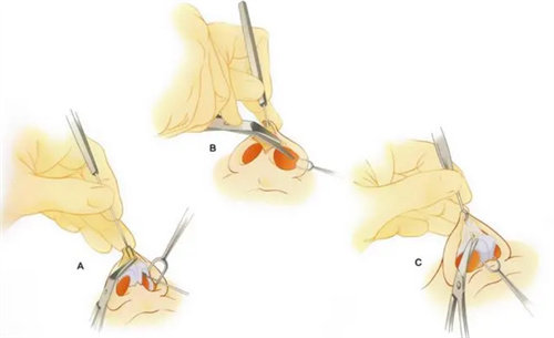 鼻子手术操作图