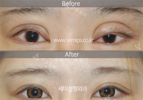 韩国世美整形外科眼修复前后图