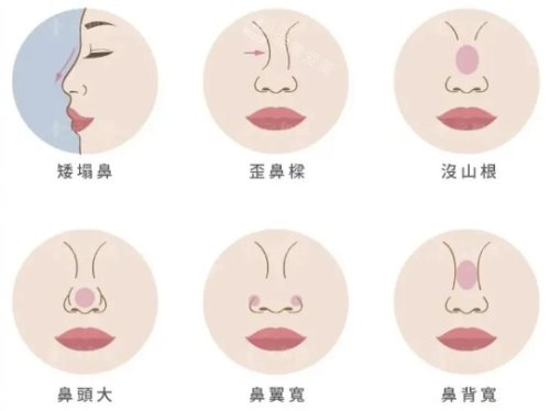 各种鼻型问题示意图