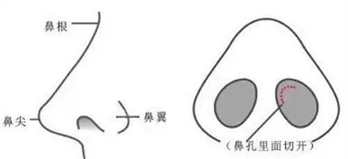 鼻子手術(shù)示意圖 鼻子手術(shù)示意圖