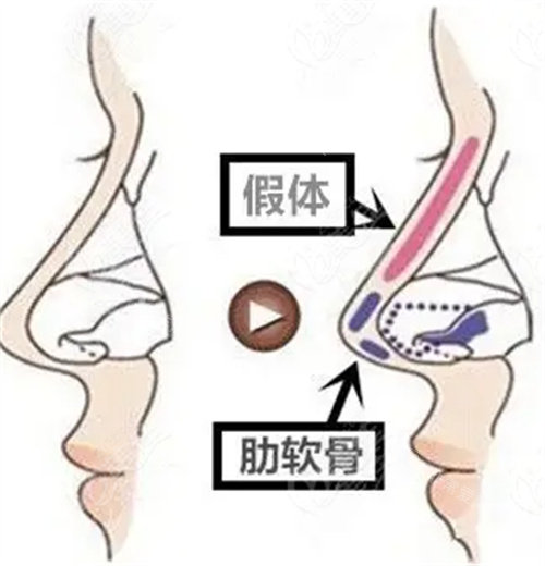 肋骨隆鼻图