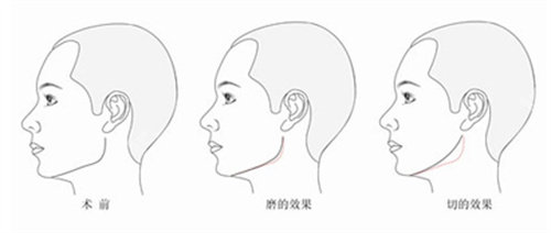 下颌角手术前后对比图 下颌角手术前后对比图