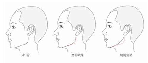 下頜角手術(shù)前后對比圖