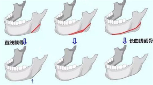 下颌角截骨手术流程图