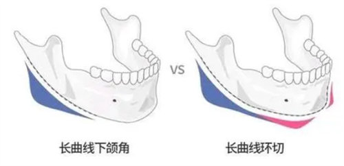 下颌角手术的两种方式展示图