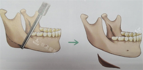下颌角截骨手术操作图