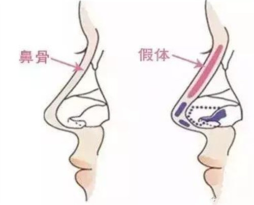 假体隆鼻图