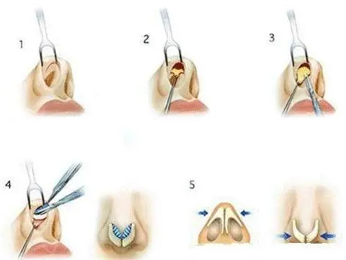 假體隆鼻手術(shù)過程圖