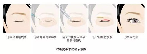 双眼皮手术过程示意图 双眼皮手术过程示意图