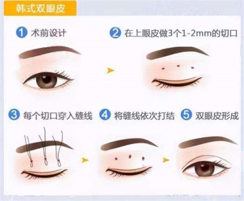 韩氏双眼皮示意图 韩氏双眼皮示意图