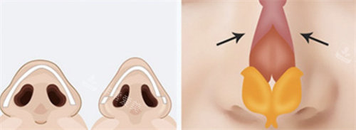 韩国必当归医院隆鼻怎么样，个性化隆鼻方案鼻子自然