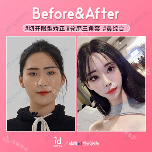 韓國ID醫(yī)院輪廓三件套對(duì)比照 韓國ID醫(yī)院輪廓三件套對(duì)比照