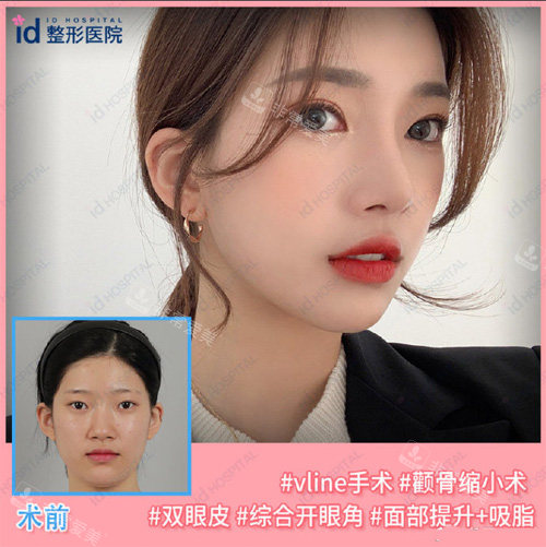 韓國ID醫(yī)院V-line+顴骨縮小手術(shù)對(duì)比照 韓國ID醫(yī)院V-line+顴骨縮小手術(shù)對(duì)比照