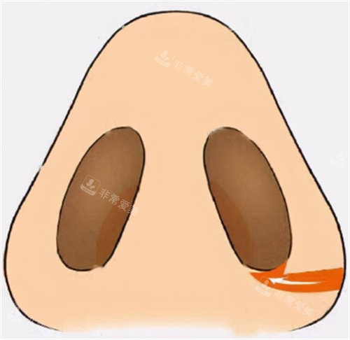 鼻翼内缩小术