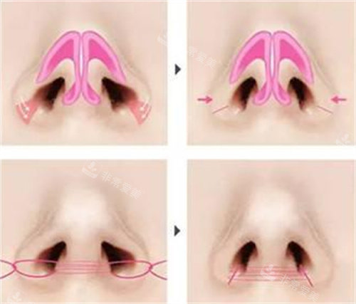 鼻翼缩小手术图