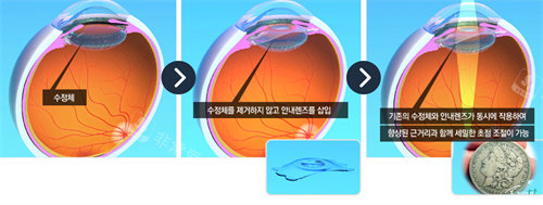 韩国江南好眼睛眼科医院白内障手术图