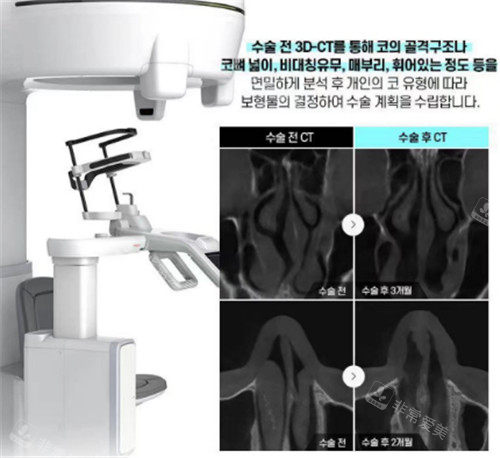韩国da整形隆鼻术前检查照片