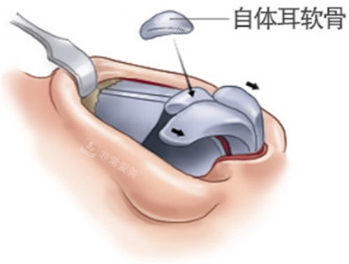 耳软骨图