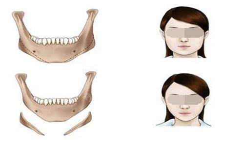 下颌角手术示意图