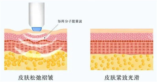 热玛吉工作原理展示图