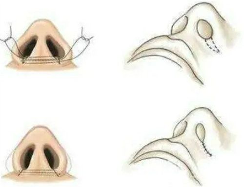 鼻翼缩小内部结构图