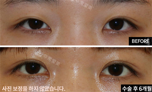 韩国EH爱护整形医院眼修复真人对比图