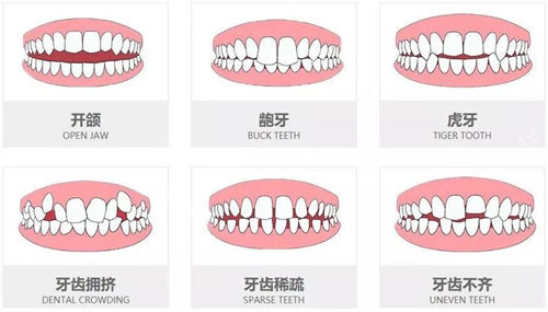 高难度牙齿矫正情况展示图