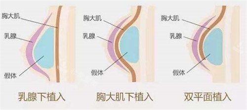 假体植入方式示意图