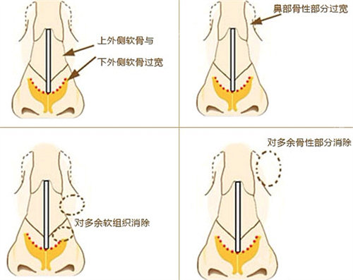 鼻骨缩小手术图 鼻骨缩小手术图