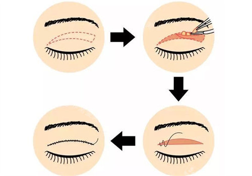 全切双眼皮手术流程图