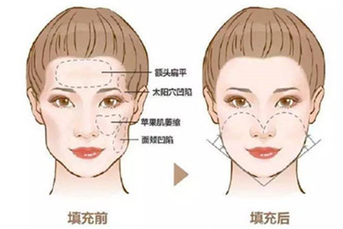 脂肪填充對(duì)比圖 脂肪填充對(duì)比圖