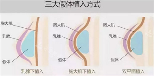假体植入的三种方法展示图 假体植入的三种方法展示图