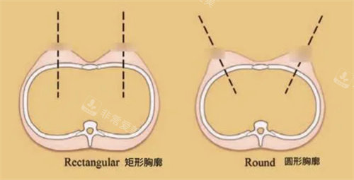 不同形状胸廓展示图