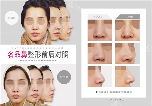 李奎昊院長名品鼻整形對比照