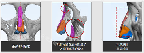 非3D打印鼻會(huì)出現(xiàn)的問題