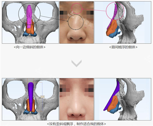 韓國歌柔飛整形外科3D定制打印鼻跟非定制假體CT 韓國歌柔飛整形外科3D定制打印鼻跟非定制假體CT