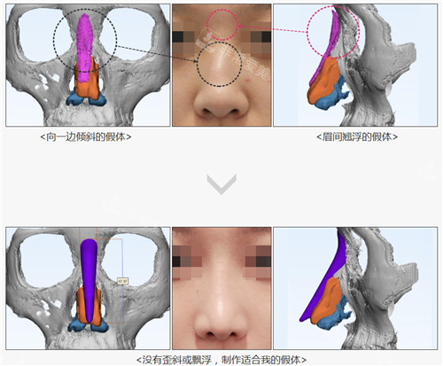 韩国歌柔飞整形外科3D定制打印鼻跟非定制假体CT
