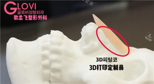 3D打印定制鼻植入鼻部状态