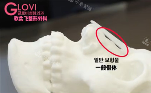 一般假體植入鼻部狀態(tài) 一般假體植入鼻部狀態(tài)