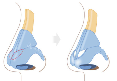 韩国格瑞丝噢爱美整形鼻中隔整形图