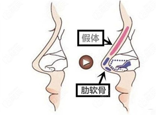 隆鼻方法動畫演示圖