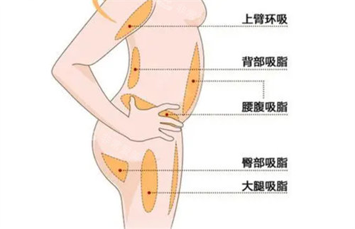 全身吸脂說(shuō)明圖 全身吸脂說(shuō)明圖