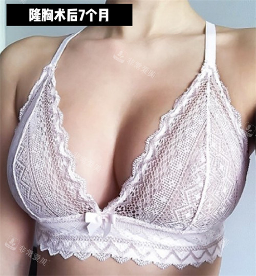 韓國(guó)ForB整形外科隆胸術(shù)后圖