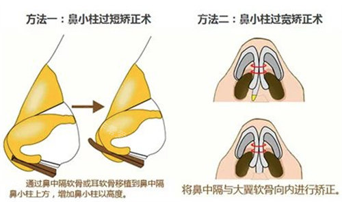 鼻小柱矯正修復(fù)圖